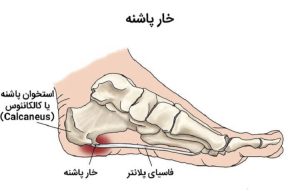 خار پاشنه چیست و راههای درمان آن